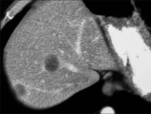 Два метастатический образований колоректального рака в печени до лечения при КТ-сканировании