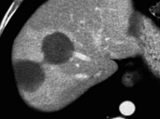 Два метастатический образований печени спустя 3 месяца после абляции при КТ-сканировании - полный некроз опухолей без признаков роста
