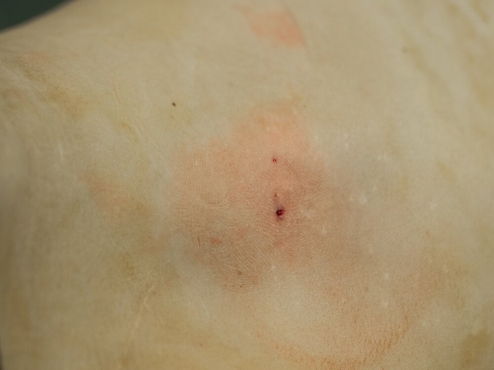 После выполнения абляции на коже остается крошечный прокол в месте введения аппликатора в опухоль